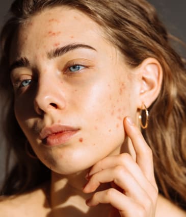 Binsina Skin & Laser Clinic - Acne (Face & Body)