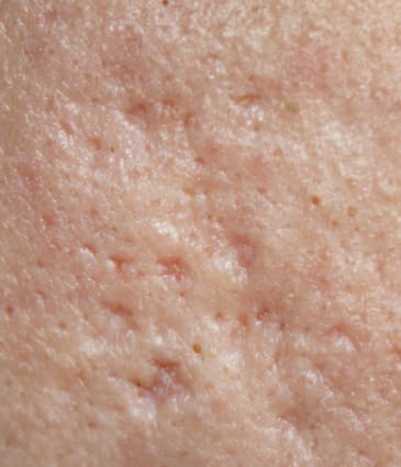 Binsina Skin & Laser Clinic - Acne Scarring 2