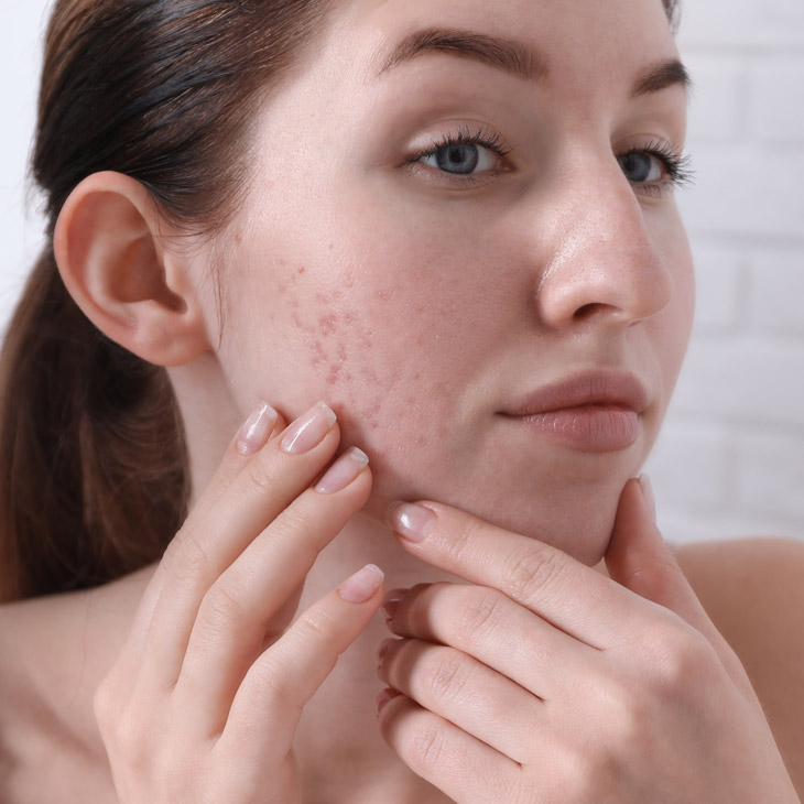 Binsina Skin & Laser Clinic - Acne Scarring 3