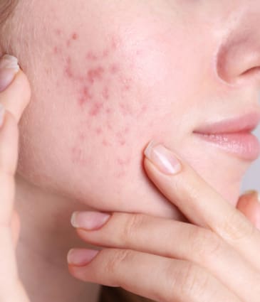 Binsina Skin & Laser Clinic - Acne Scarring