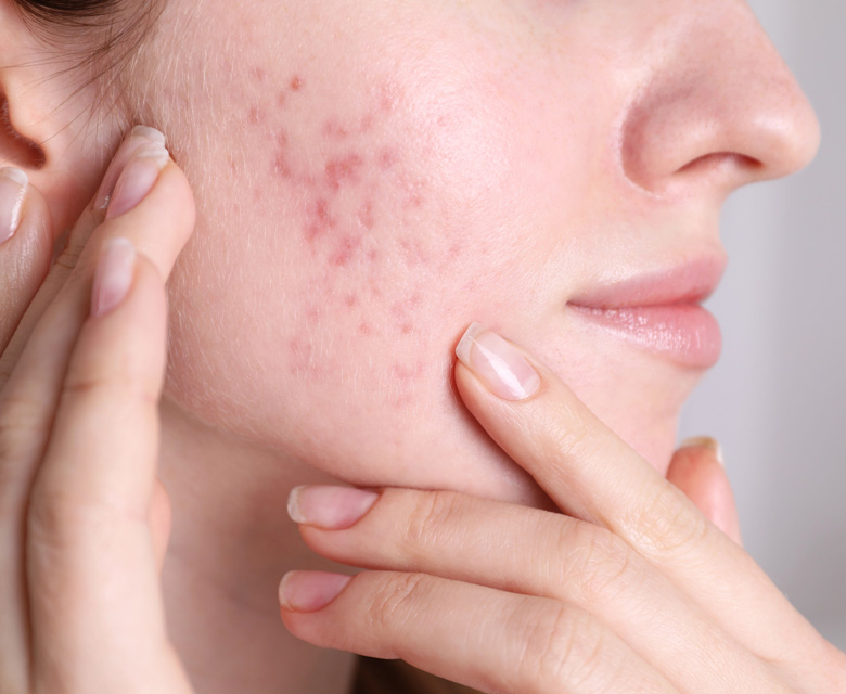 Binsina Skin & Laser Clinic - Acne Scarring