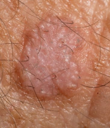 Binsina Skin & Laser Clinic - Actinic Keratosis 2