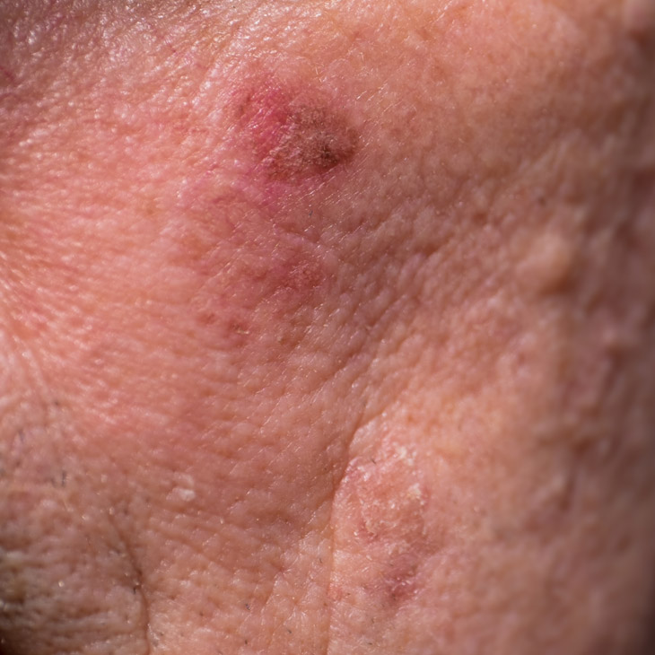Binsina Skin & Laser Clinic - Actinic Keratosis 3
