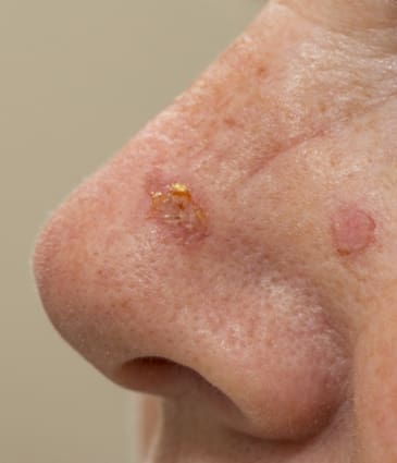 Binsina Skin & Laser Clinic - Actinic Keratosis