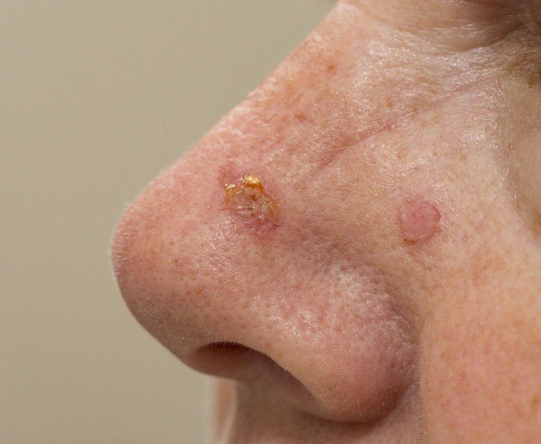 Binsina Skin & Laser Clinic - Actinic Keratosis