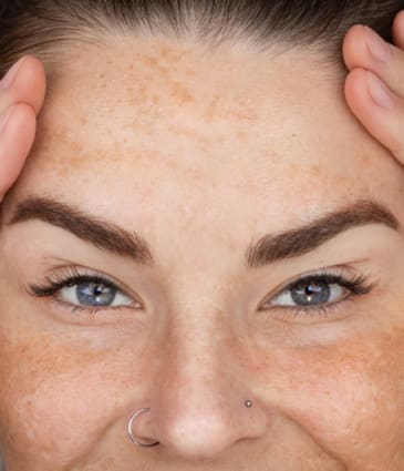 Binsina Skin & Laser Clinic - Age Spots 2