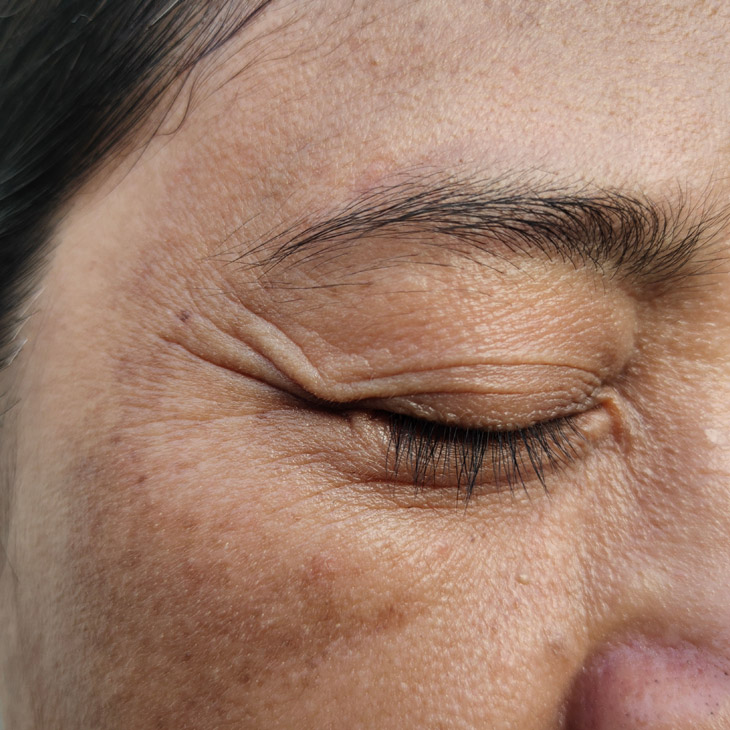 Binsina Skin & Laser Clinic - Age Spots 3