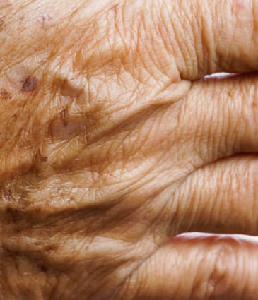 Binsina Skin & Laser Clinic - Ageing Hands