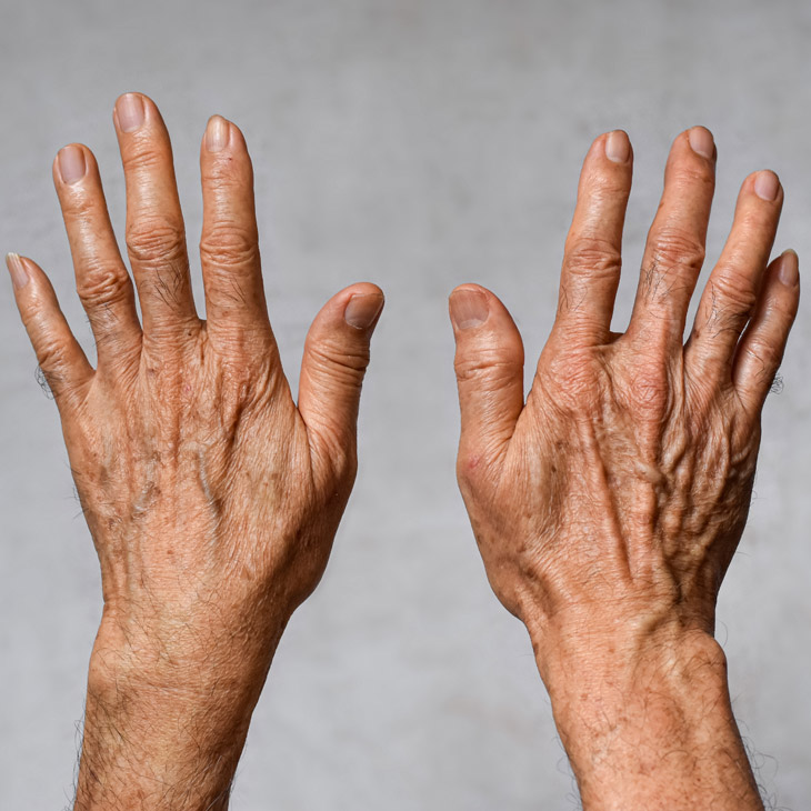 Binsina Skin & Laser Clinic - Ageing Hands