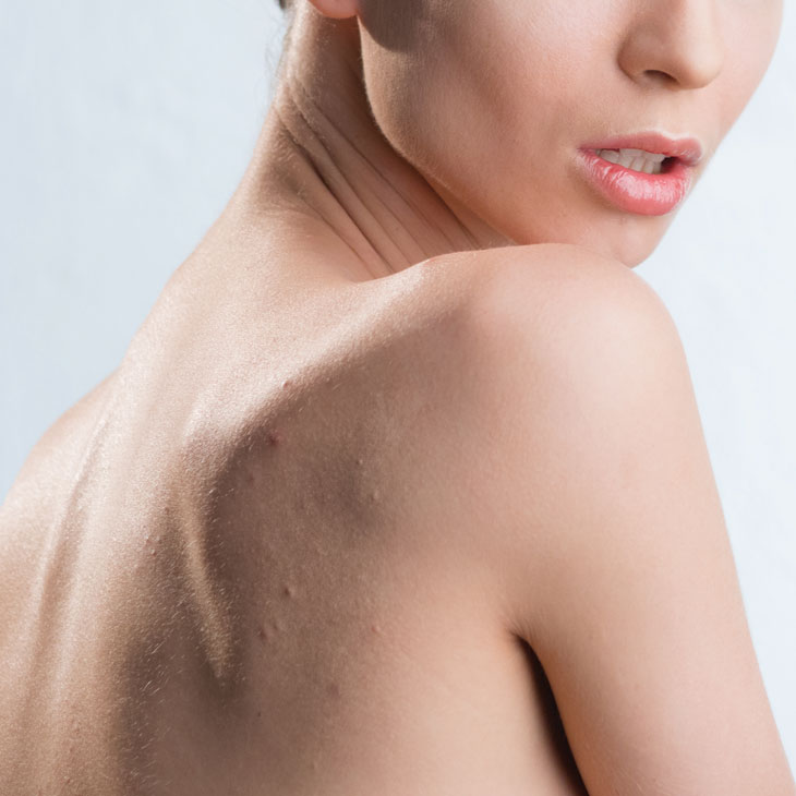 Binsina Skin & Laser Clinic - Back Acne 2