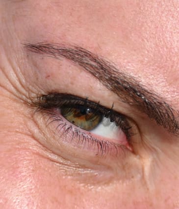 Binsina Skin & Laser Clinic - Crow’s Feet