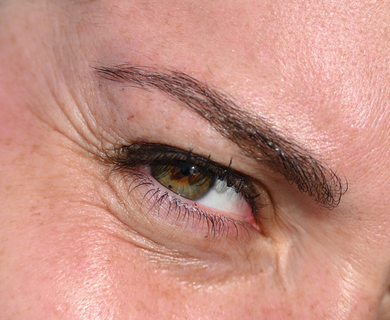 Binsina Skin & Laser Clinic - Crow’s Feet