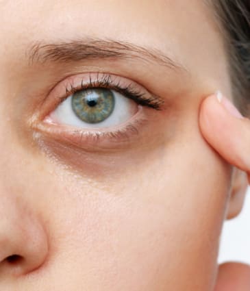 Binsina Skin & Laser Clinic - Dark Circles 2