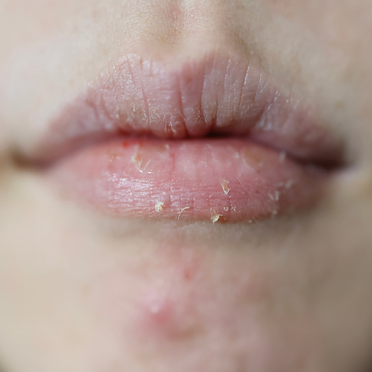 Binsina Skin & Laser Clinic - Dry Lips 3