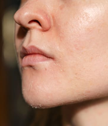 Binsina Skin & Laser Clinic - Dull & Dry Skin 2