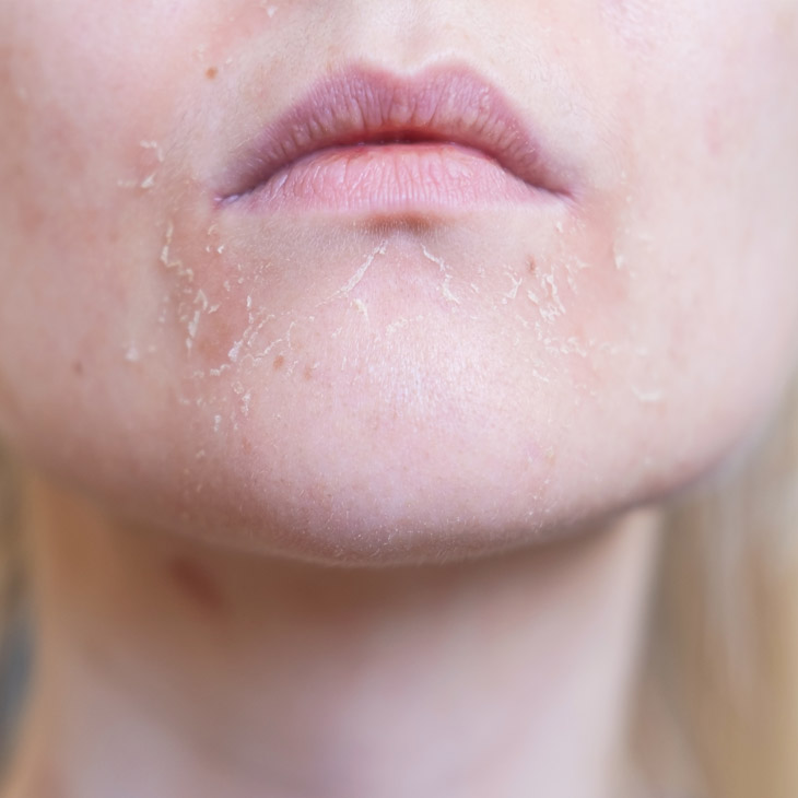 Binsina Skin & Laser Clinic - Dull & Dry Skin 3