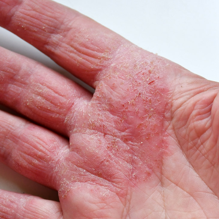 Binsina Skin & Laser Clinic - Eczema 3