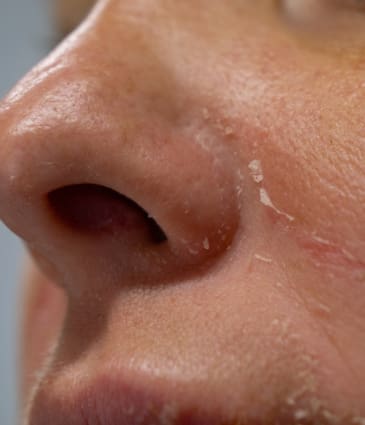 Binsina Skin & Laser Clinic - Eczema