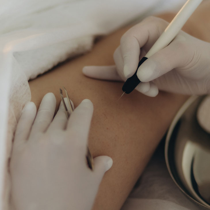 Binsina Skin & Laser Clinic - Electrolysis 2