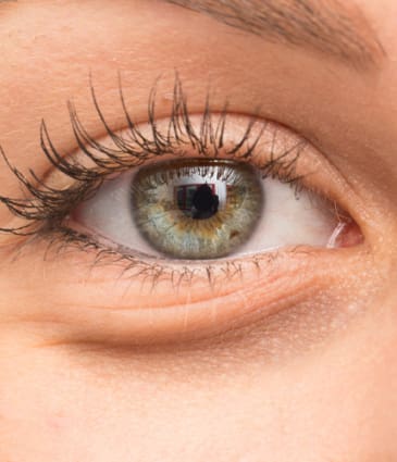 Binsina Skin & Laser Clinic - Eye Bags 2