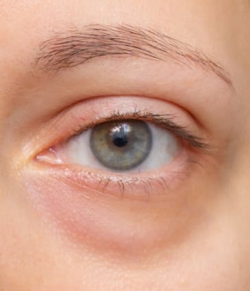 Binsina Skin & Laser Clinic - Eye Bags