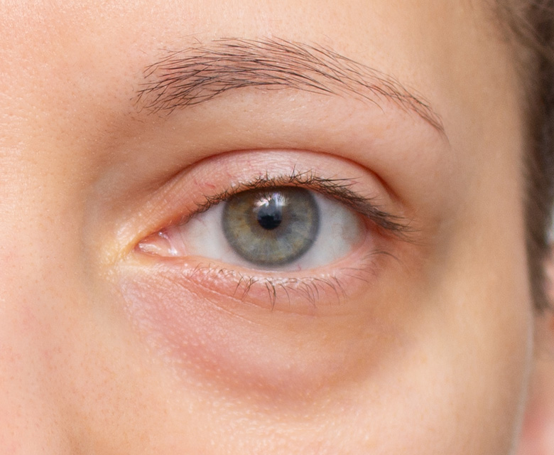 Binsina Skin & Laser Clinic - Eye Bags