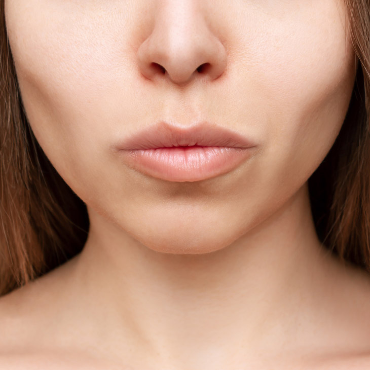 Binsina Skin & Laser Clinic - Facial Volume Loss