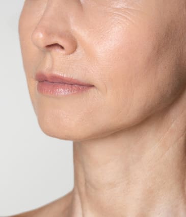 Binsina Skin & Laser Clinic - Fine Lines & Wrinkles 2