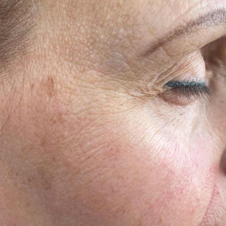 Binsina Skin & Laser Clinic - Fine Lines & Wrinkles 3