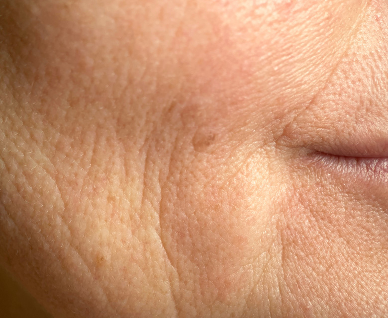 Binsina Skin & Laser Clinic - Fine Lines & Wrinkles