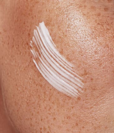 Binsina Skin & Laser Clinic - Freckles 2