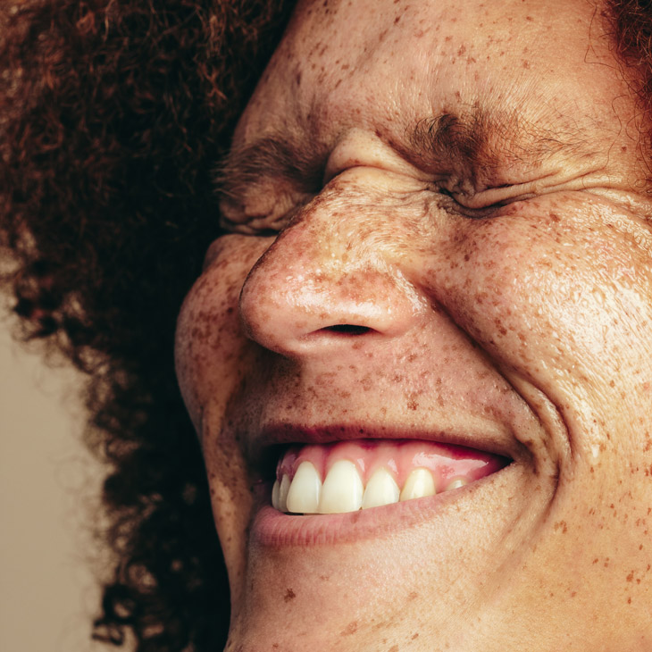 Binsina Skin & Laser Clinic - Freckles 3