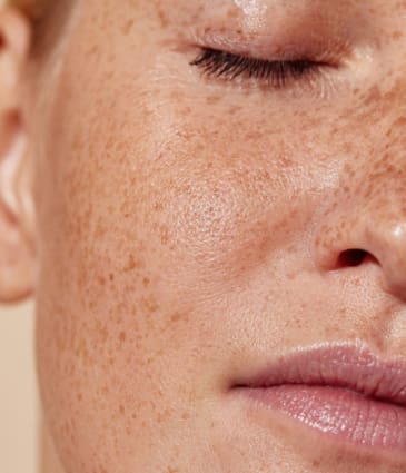 Binsina Skin & Laser Clinic - Freckles