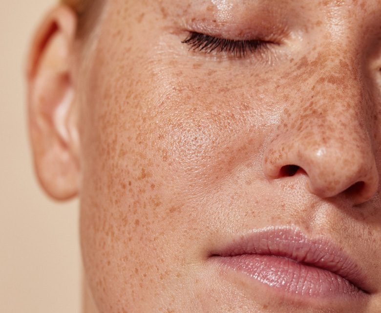 Binsina Skin & Laser Clinic - Freckles