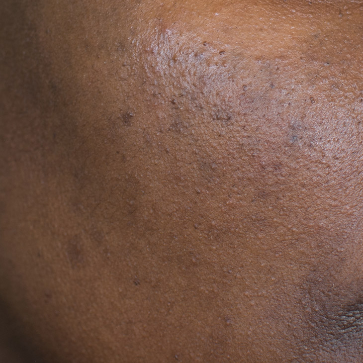 Binsina Skin & Laser Clinic - Hyperpigmentation 3