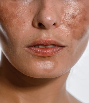 Binsina Skin & Laser Clinic - Hyperpigmentation