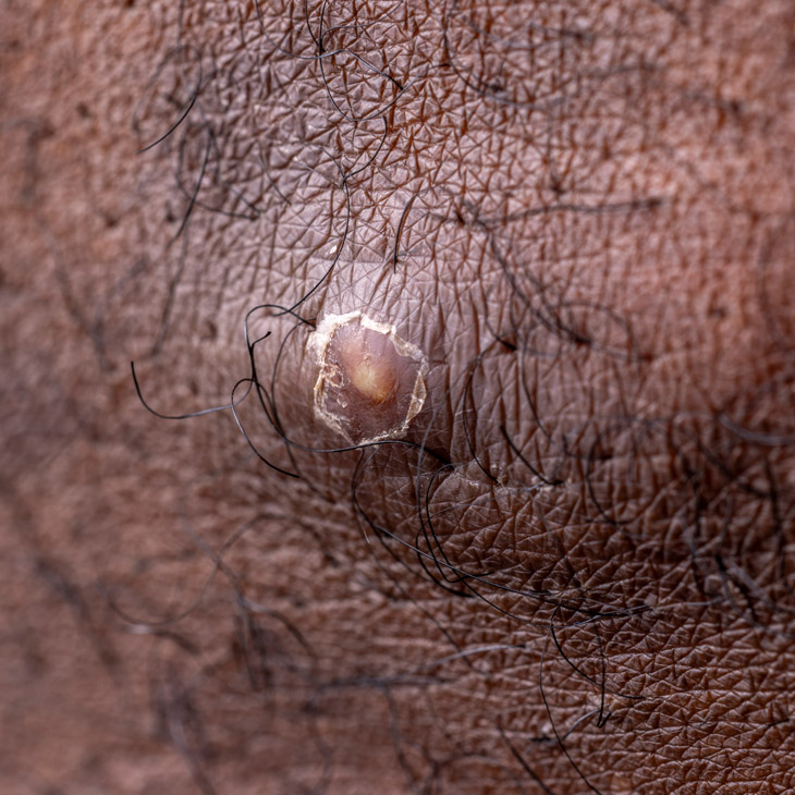 Binsina Skin & Laser Clinic - Ingrown Hair 3