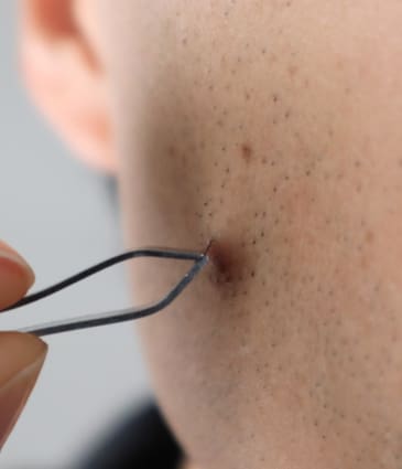 Binsina Skin & Laser Clinic - Ingrown Hair