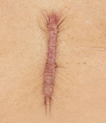 Binsina Skin & Laser Clinic - Keliods scarring 2