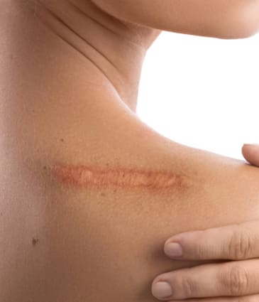 Binsina Skin & Laser Clinic - Keliods scarring