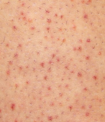 Binsina Skin & Laser Clinic - Keratosis Pilaris 2