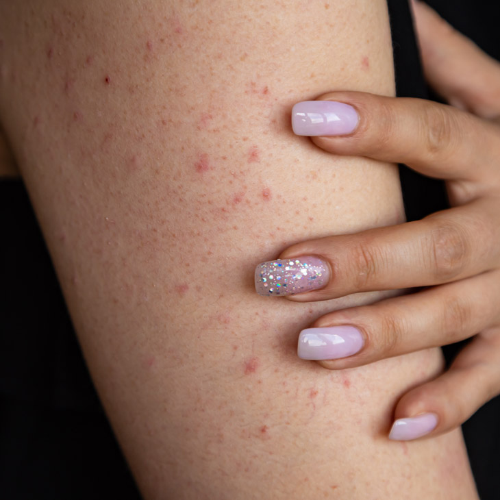 Binsina Skin & Laser Clinic - Keratosis Pilaris 3