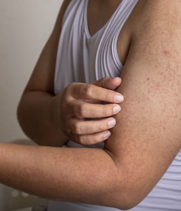 Binsina Skin & Laser Clinic - Keratosis Pilaris