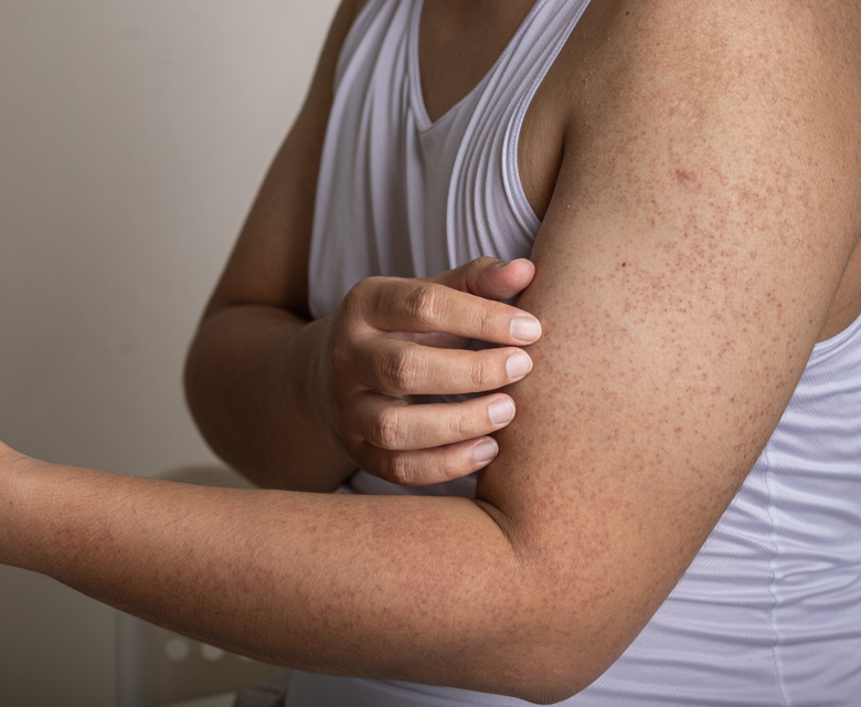 Binsina Skin & Laser Clinic - Keratosis Pilaris