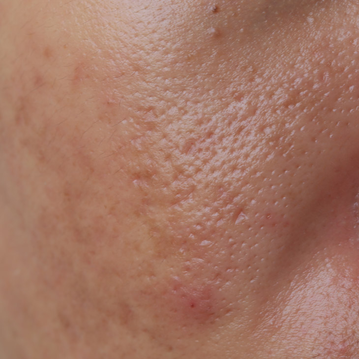 Binsina Skin & Laser Clinic - Large Pores 3