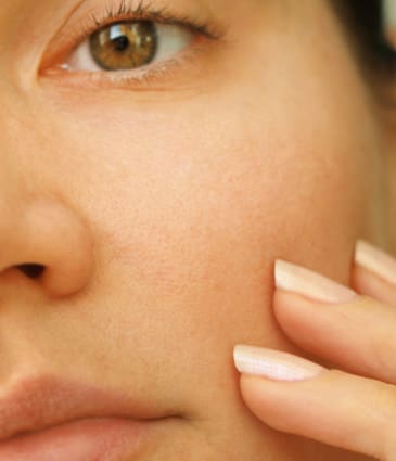 Binsina Skin & Laser Clinic - Large Pores