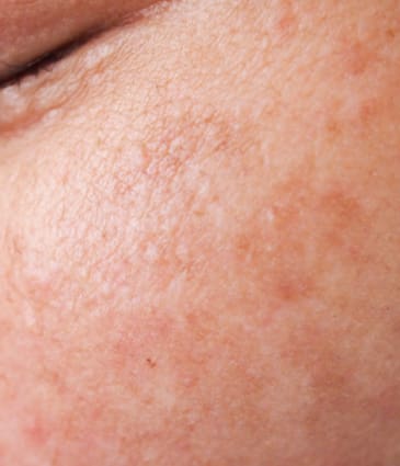 Binsina Skin & Laser Clinic - Melasma 2