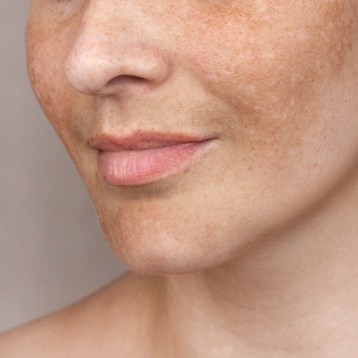 Binsina Skin & Laser Clinic - Melasma 3