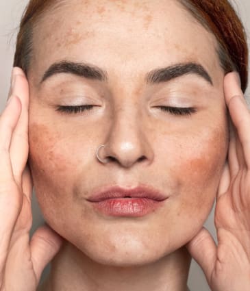 Binsina Skin & Laser Clinic - Melasma