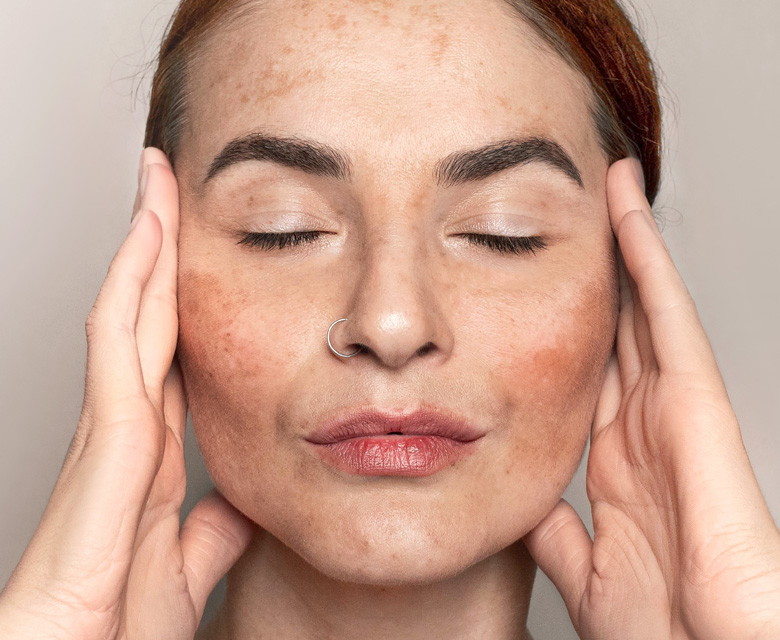 Binsina Skin & Laser Clinic - Melasma